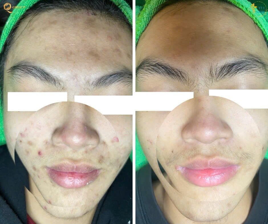 Kết quả chăm sóc da tại YLISKIN 1