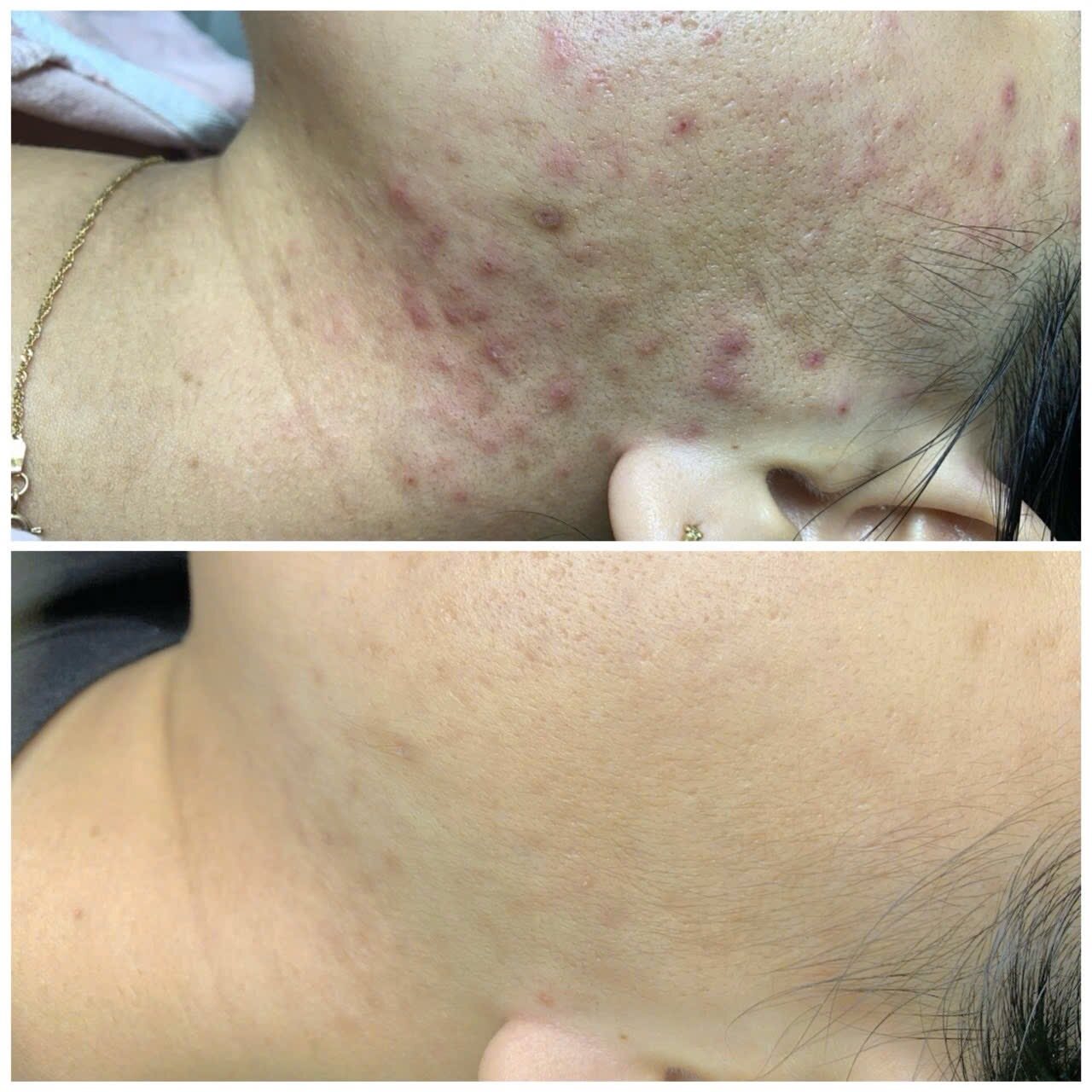 Kết quả chăm sóc da tại YLISKIN 2