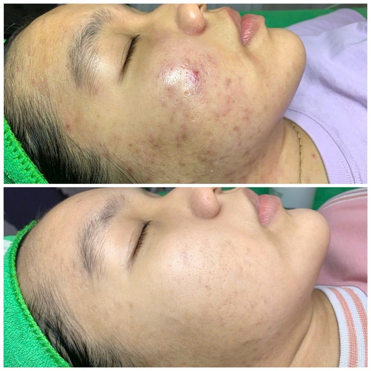 Kết quả chăm sóc da tại YLISKIN 3