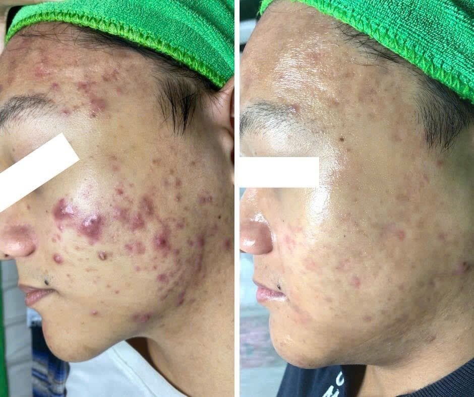 Kết quả chăm sóc da tại YLISKIN 4