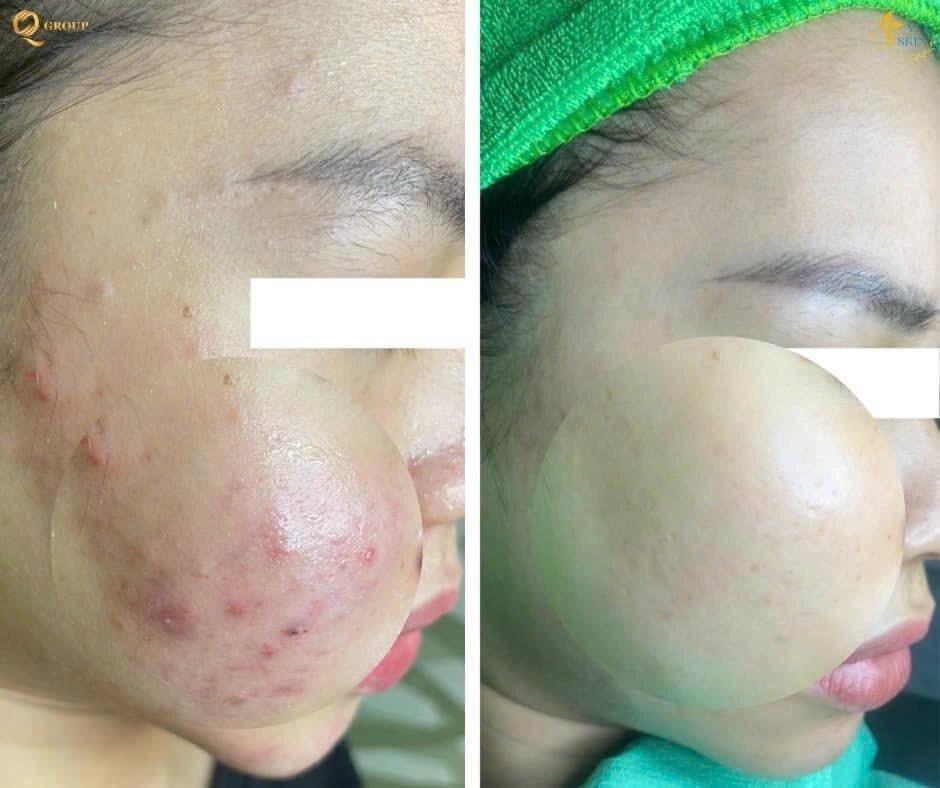 Kết quả chăm sóc da tại YLISKIN 5