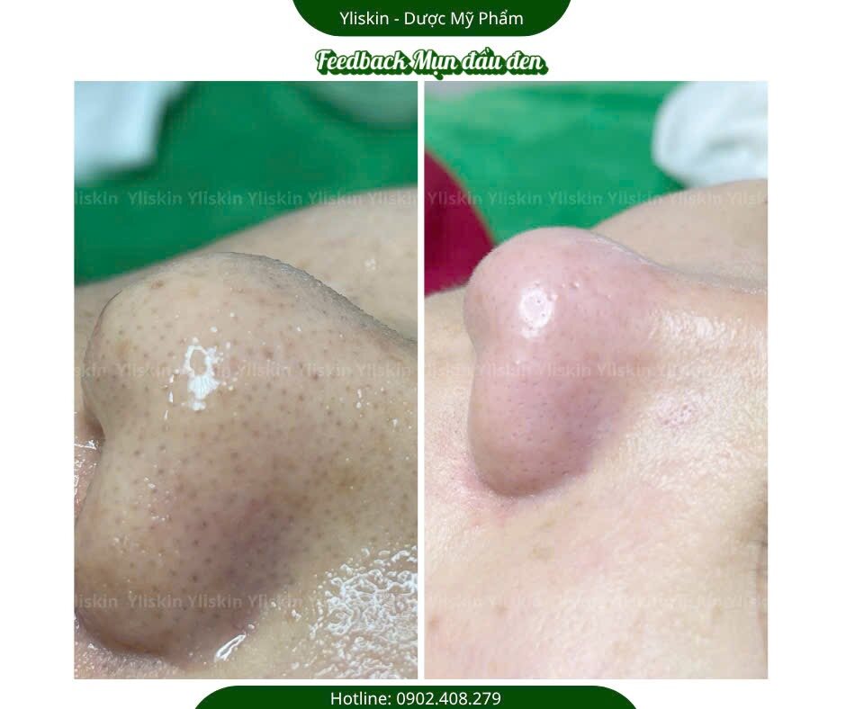 Kết quả chăm sóc da tại YLISKIN 6
