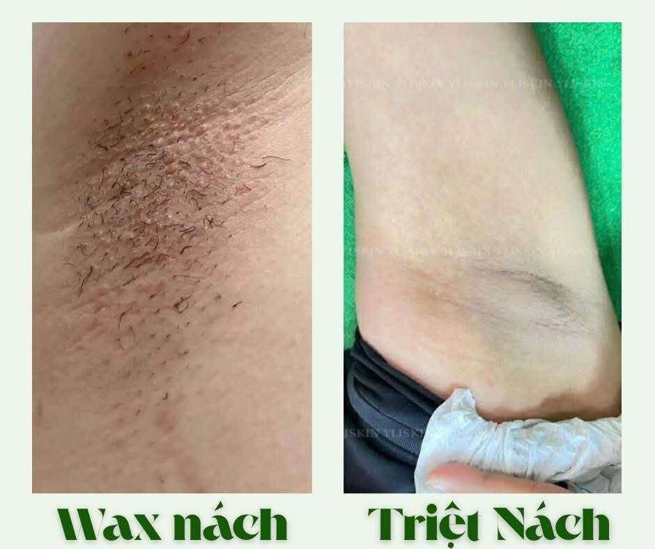 Kết quả triệt lông tại YLISKIN